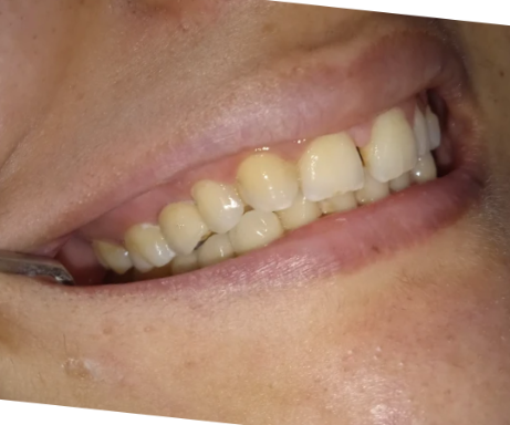 Smile restoration after treatment